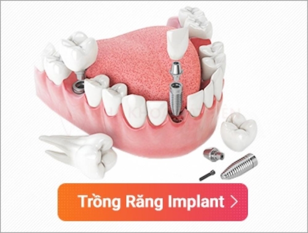 Trồng răng Implant - Nha Khoa Cát Tiên - Công Ty TNHH Thương Mại Dịch Vụ Nha Khoa Cát Tiên